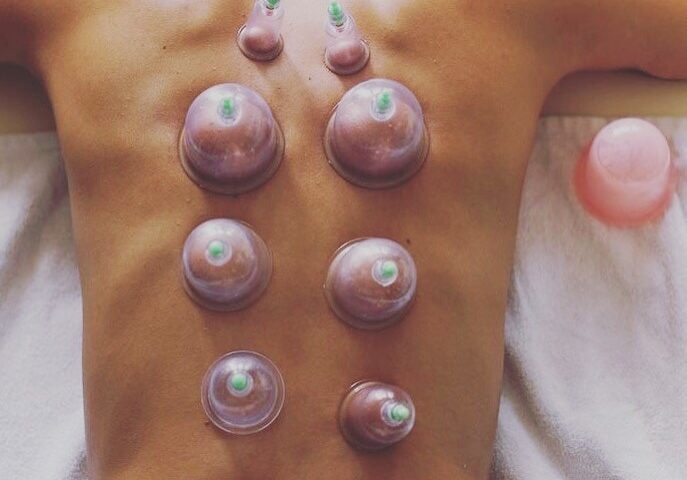 Cupping