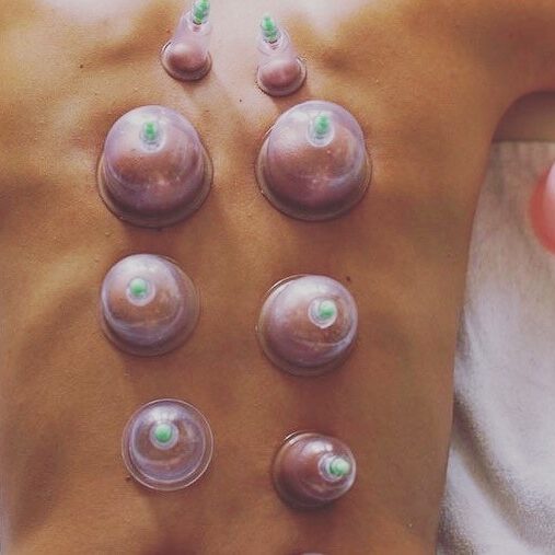 Cupping